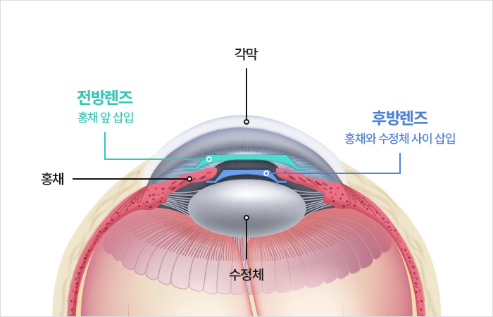 렌즈삽입술 종류 이미지